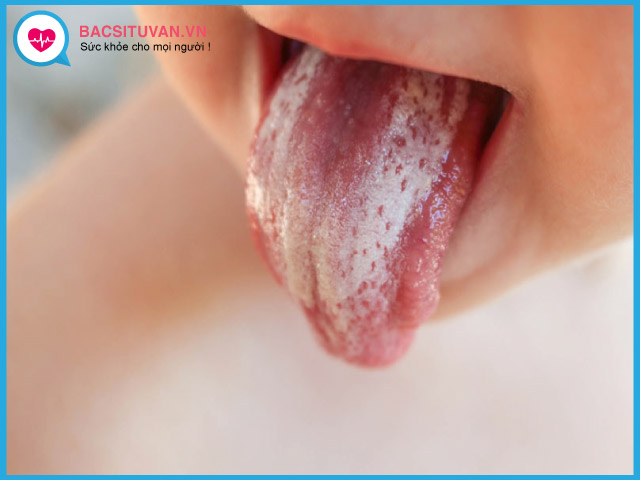 Triệu chứng thường gặp của tưa miệng