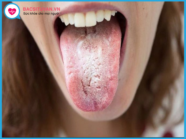 Biểu hiện triệu chứng của nấm lưỡi