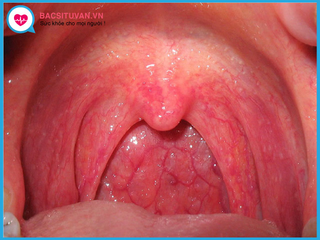 Dấu hiệu viêm họng cấp tính do nhiễm khuẩn