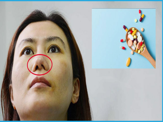 Điều trị vẹo vách ngăn mũi bằng thuốc
