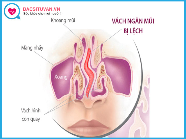 Nguyên nhân gây vẹo vách ngăn mũi