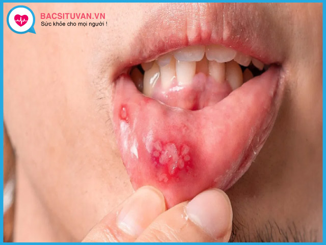 Tìm hiểu về bệnh loét miệng