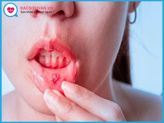 Triệu chứng loét miệng