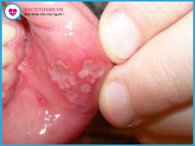 Vết loét miệng dạng Herpes