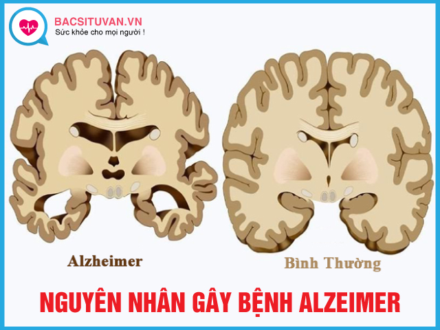Bệnh Alzheimer xuất phát từ nguyên nhân nào?
