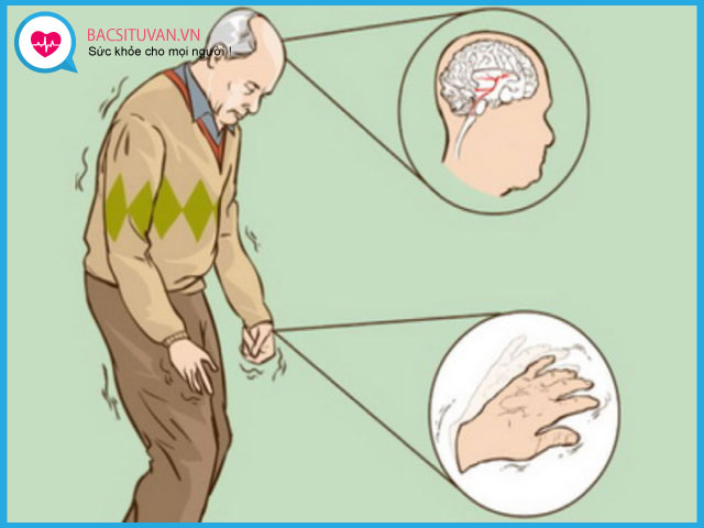 Bệnh Parkinson và các biểu hiện bệnh