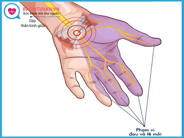 Biểu hiện lâm sàng của hội chứng ống cổ tay