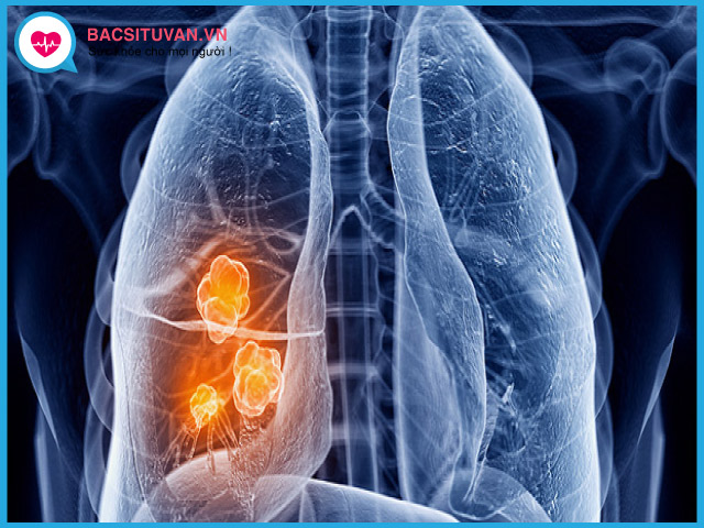 Chẩn đoán giai đoạn ung thư phổi không tế bào nhỏ theo TNM