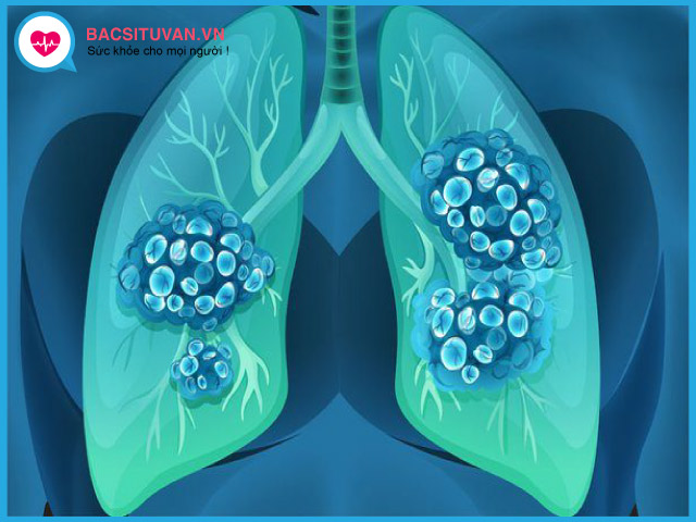 Chẩn đoán giai đoạn ung thư phổi tế bào nhỏ theo TNM