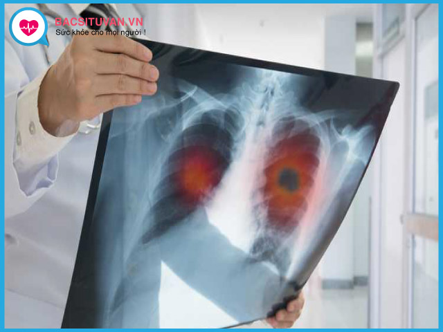 Chụp x-quang để chẩn đoán ung thư phổi tế bào nhỏ