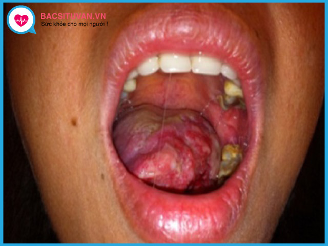 Dấu hiệu nhận biết giai đoạn cuối ung thư lưỡi