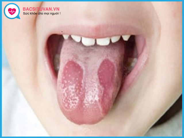 Dấu hiệu nhận biết giai đoạn đầu ung thư lưỡi