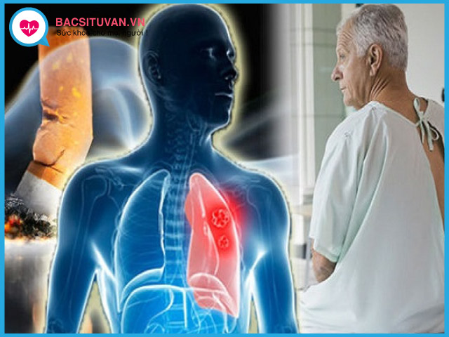 Nguyên nhân và yếu tố nguy cơ gây ung thư phổi tế bào nhỏ