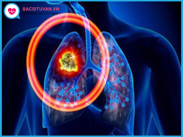 Tìm hiểu về bệnh ung thư phổi tế bào nhỏ
