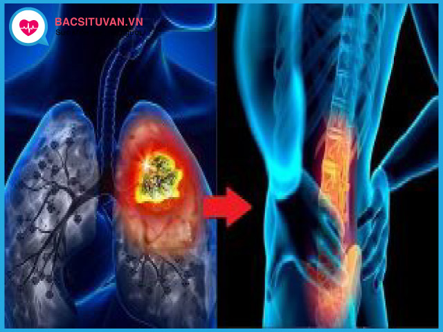 Ung thư phổi tế bào nhỏ có thể gây ảnh hưởng đến cả xương khớp và thận