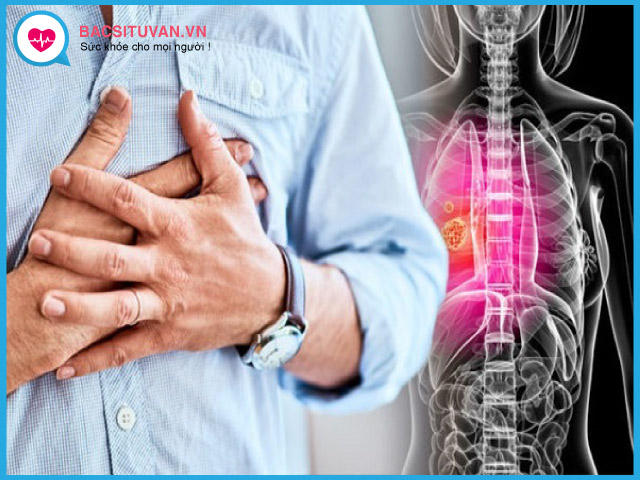 Ung thư phổi tế bào nhỏ có thể gây chèn ép dây thần kinh, tràn dịch màng tim, phổi